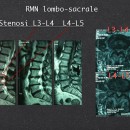 Risonanaza magnetica preoperatoria che mostra la presenza di una stenosi (restringimento) del canale spinale tra L3-L4 ed L4-L5. Immagini sui piani sagittali e assiali