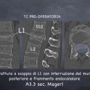 Frattura a scoppio di L1 con frammento nel canale spinale. Frattura A3.3 secondo la classificazione di Magerl.