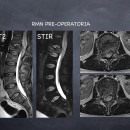Risonanza preoperatoria (sequenzaT2) nei piani saggittali (a destra) e assiali (a sinistra) che mostra la frattura di L1 con l\\\'invasione del canale spinale (vertebra iperintensa - più chiara)