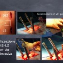 Trattamento mininvasivo della frattura vertebrale, si effettuano quattro piccole incisione e con controllo radiologico intraoperatorio si posizionanao viti peduncolari nelle vertebre adiatcenti (D12 - L2)