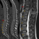 Figura 1: Tomografia Computerizzata (sinistra) e Risonanza Magnetica (destra) frattura instabile della colonna dorsale a livello di d12. Notare la compressione midollare evidente in RM.