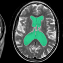Figura 1: Sequenze T2 di Risonanza Magnetica che mostrano quadro di idrocefalo tetraventricolare, ventricoli cerebrali evidenziati in verde, compatibile con la diagnosi di idrocefalo normoteso in un paziente di oltre 65 anni.